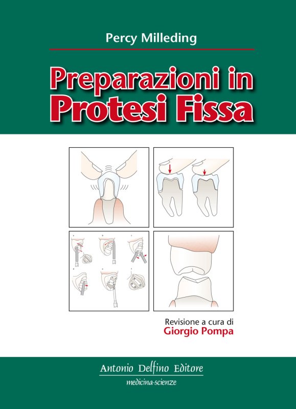 Preparazioni in protesi fissa