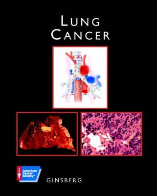 Lung Cancer