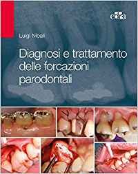 Diagnosi e trattamento delle forcazioni parodontali