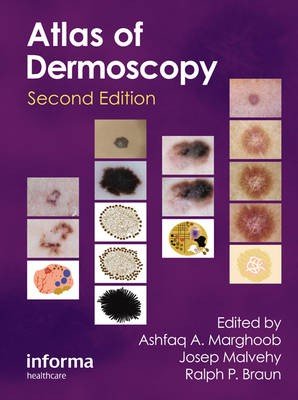 An Atlas of Dermoscopy