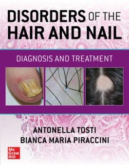 Disorders of the hair and nail: diagnosis and treatment