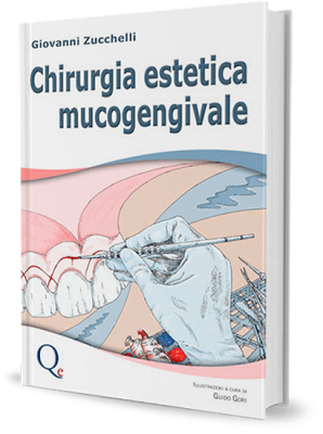 Chirurgia estetica mucogengivale