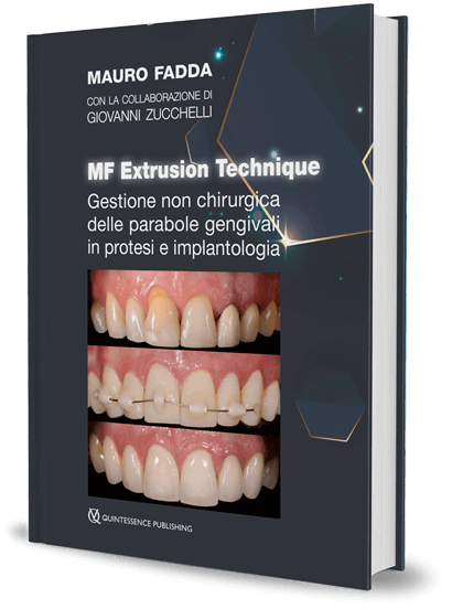 Gestione non chirurgica delle parabole gengivali in protesi e implantologia. MF extrusion technique