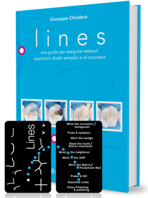 Lines. Una guida per eseguire restauri posteriori diretti semplici e di successo