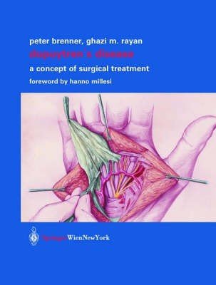 Dupuytren's Disease