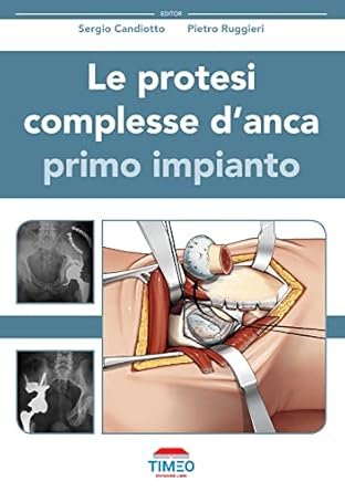 Le protesi complesse d'anca. Primo impianto