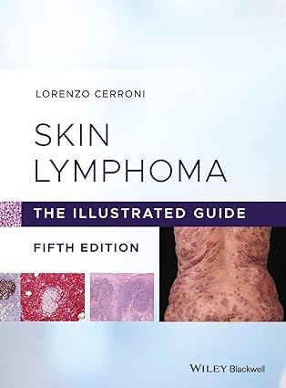 Skin Lymphoma