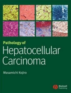 Pathology of Hepatocellular Carcinoma