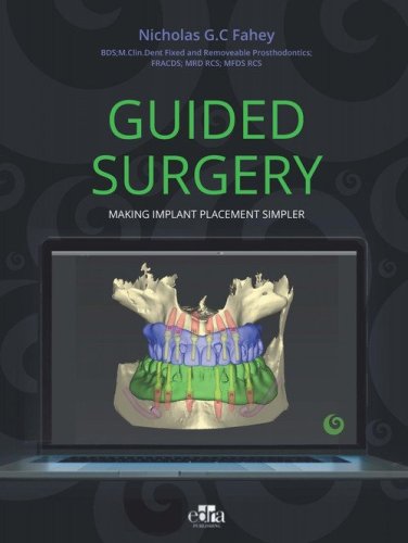 Guided surgery. Making implant placement simpler