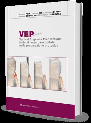 VEP. Vertical edgeless preparation: la dominanza parodontale nella preparazione protesica
