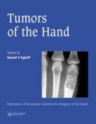 Tumors of the hand