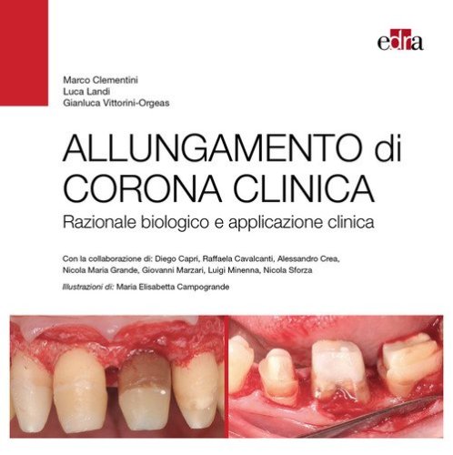 Allungamento di corona clinica. Razionale biologico e applicazione clinica