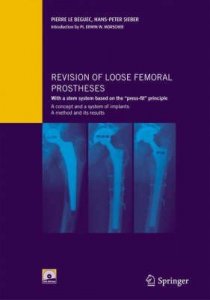 Revision of Loose Femoral Prostheses with a Stem System Based on the "Press-fit" Principle